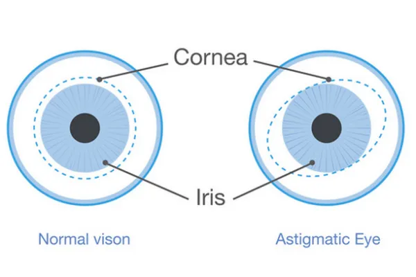 Astigmatism vs. Normal Vision: A Detailed Look at Key Differences